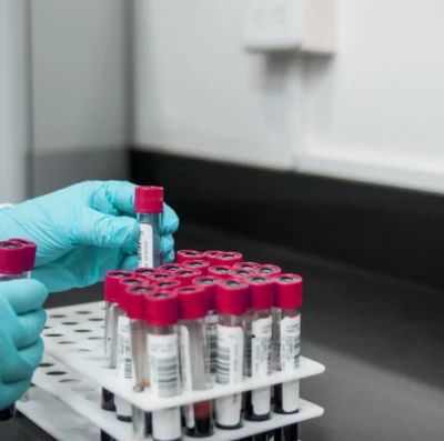 Pesquisas brasileiras avançam no diagnóstico de Alzheimer