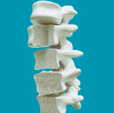 Osteoporose avança em silêncio e atinge milhões no Brasil sem diagnóstico