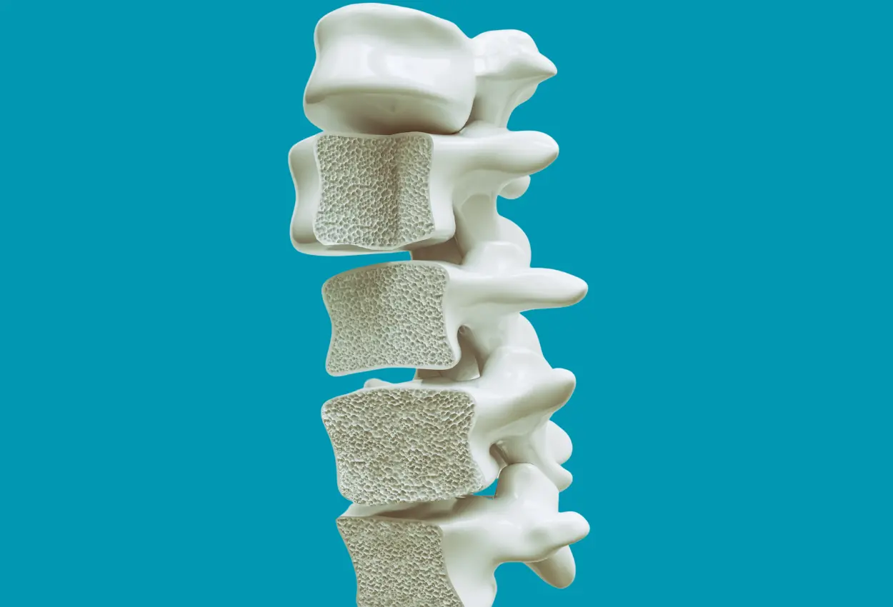 Osteoporose avança em silêncio e atinge milhões no Brasil sem diagnóstico