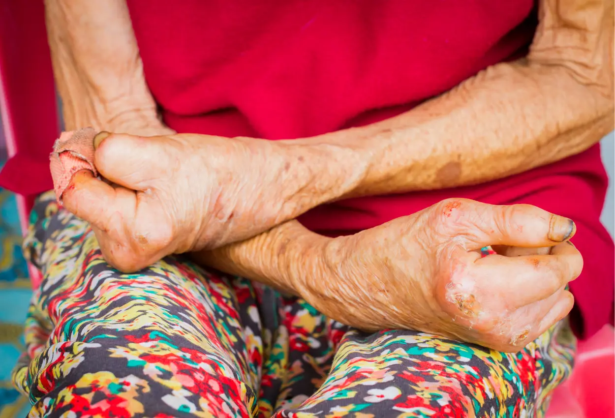 Hanseníase saiba tudo sobre a doença e veja como o diagnóstico precoce auxilia na cura plena