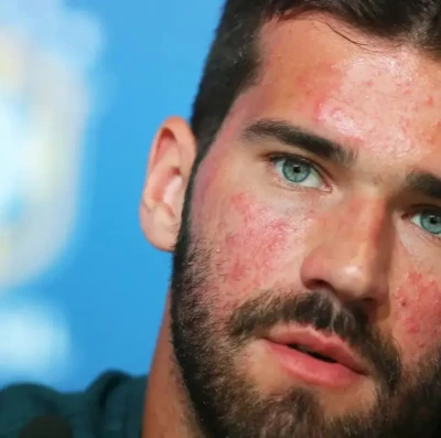 O que é rosácea Dermatologista explica doença do goleiro Alisson Becker