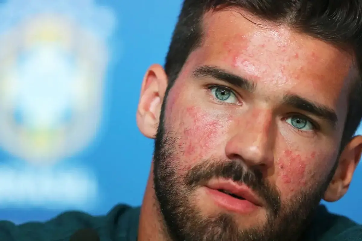 O que é rosácea Dermatologista explica doença do goleiro Alisson Becker