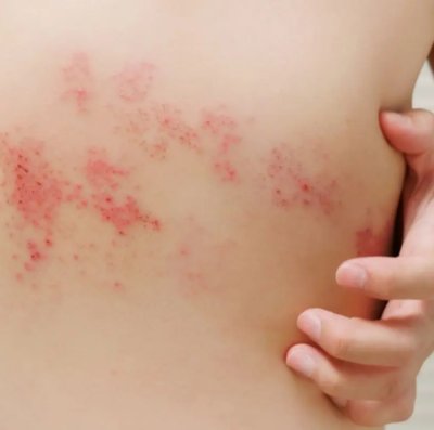 vacina contra herpes-zóster no SUS