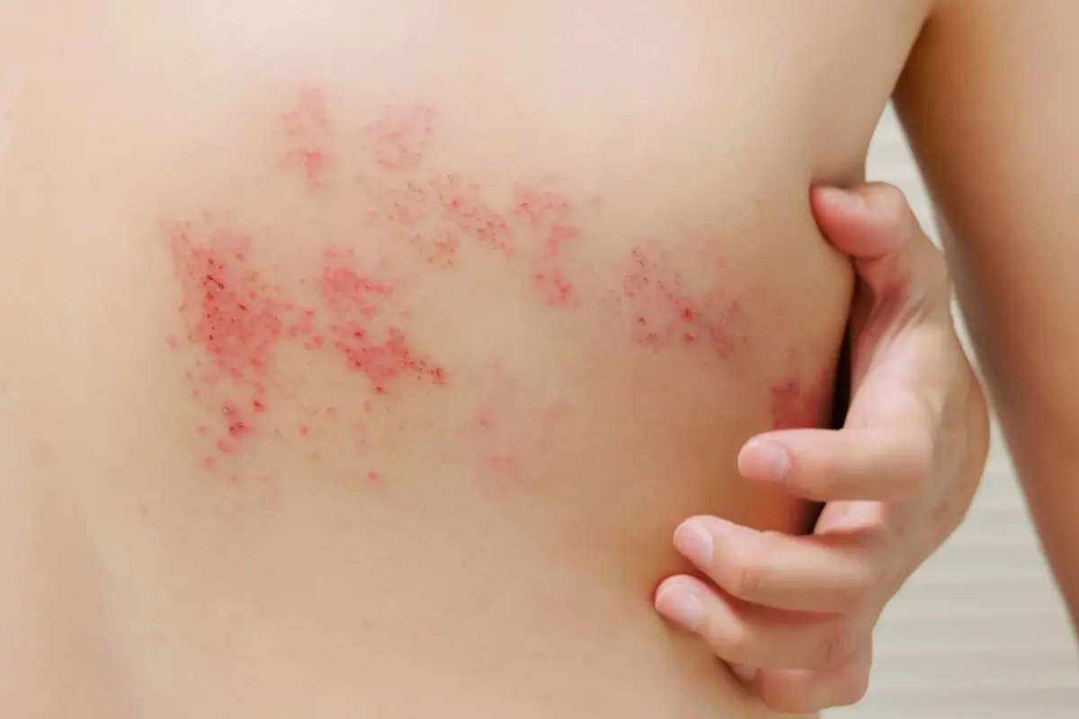 Vacina contra herpes-zóster no SUS avança e pode atender maiores de 50 anos