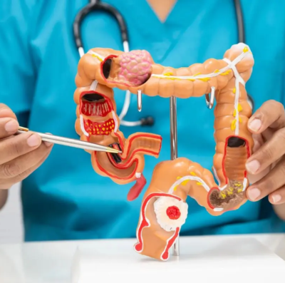 câncer de intestino