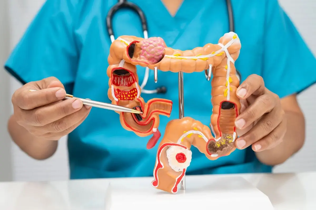 Câncer de intestino pode avançar sem sintomas; Goiânia deve registrar 530 novos casos